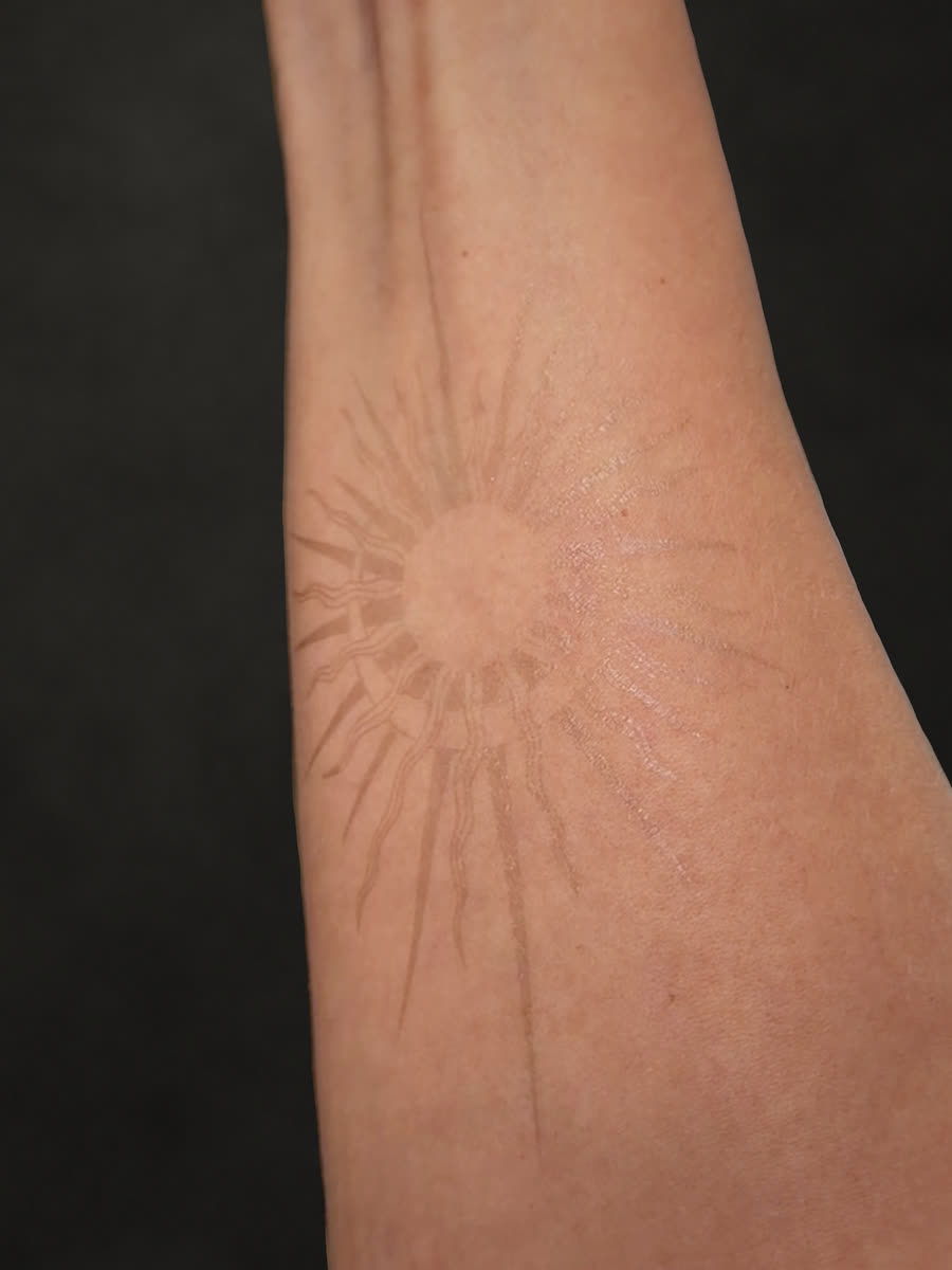 Direkt danach: Sonnen-Tattoo am Unterarm, noch hell
